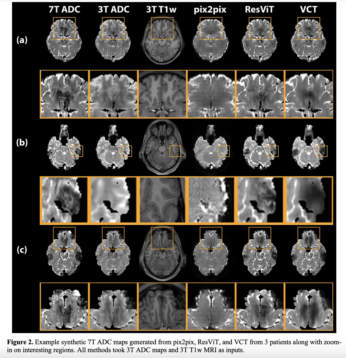 High-resolution 3T To 7T MRI Synthesis With A Hybrid CNN-Transformer ...